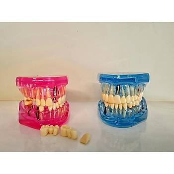 Tm105 Implant Kpr Model